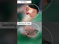 Deep plane Face lift surgery #shorts