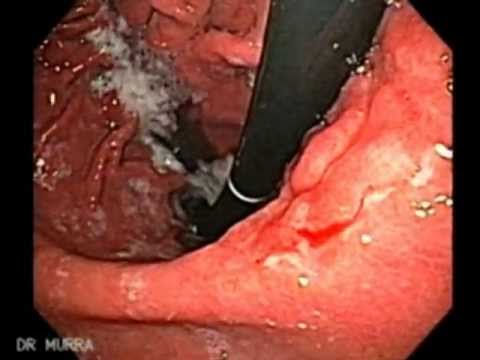 Signet Ring Cell Carcinoma Colon Symptoms Signet Ring Cell Carcinoma Colon Symptoms