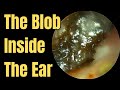 The Blob Inside The Ear