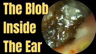 The Blob Inside The Ear