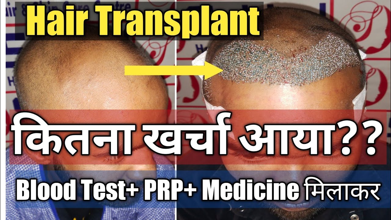 Hair Transplant in India Hair Transfer & Hair Translate Kaise hota h