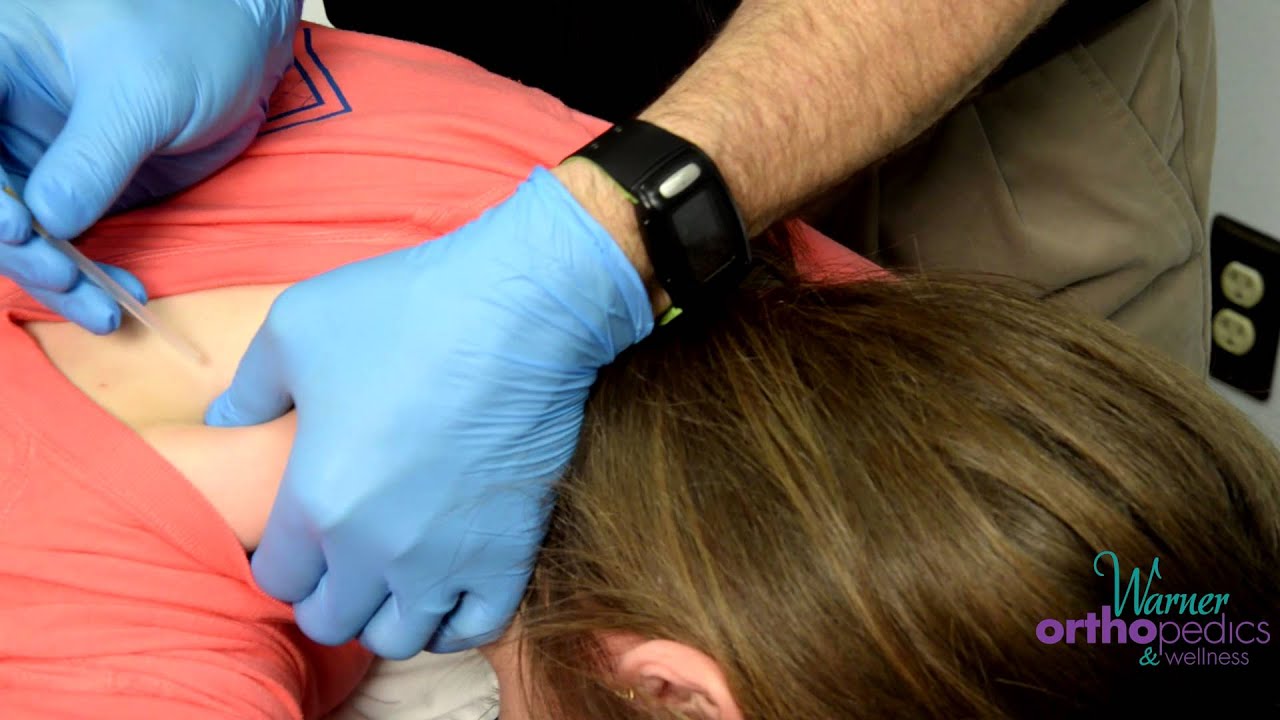 Does Dry Needling Hurt? Dry Needling Demonstration