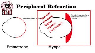 Theories of Myopia Development and Progression Source