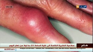 3 دقائق صحة:تورمات الأصابع  ..ما هي و ما أسبابها!!