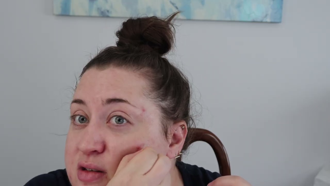 Действуют ли эти пластыри? Невидимые пластыри от прыщей OmaDoto для лица.