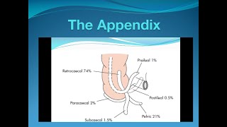 Acute Appendicitis