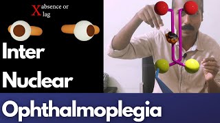 Video 2- Lesions affecting lateral gaze: Internuclear Ophthalmoplegia and more!