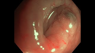 Cold EMR for a polyp of the appendix