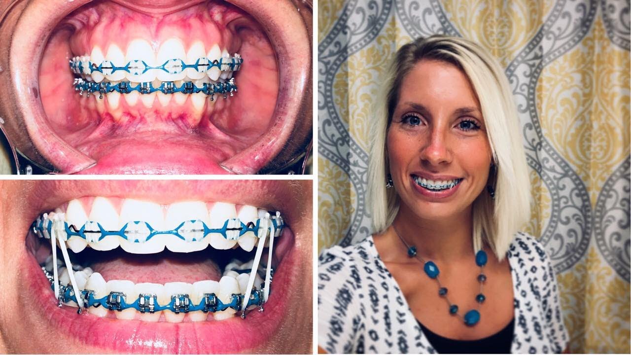 "ADULT BRACES" 17 Months - BIG CHANGES SOON!