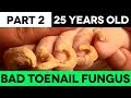 25 Years Old Severe Toenail Fungus Treatment (PART 2)