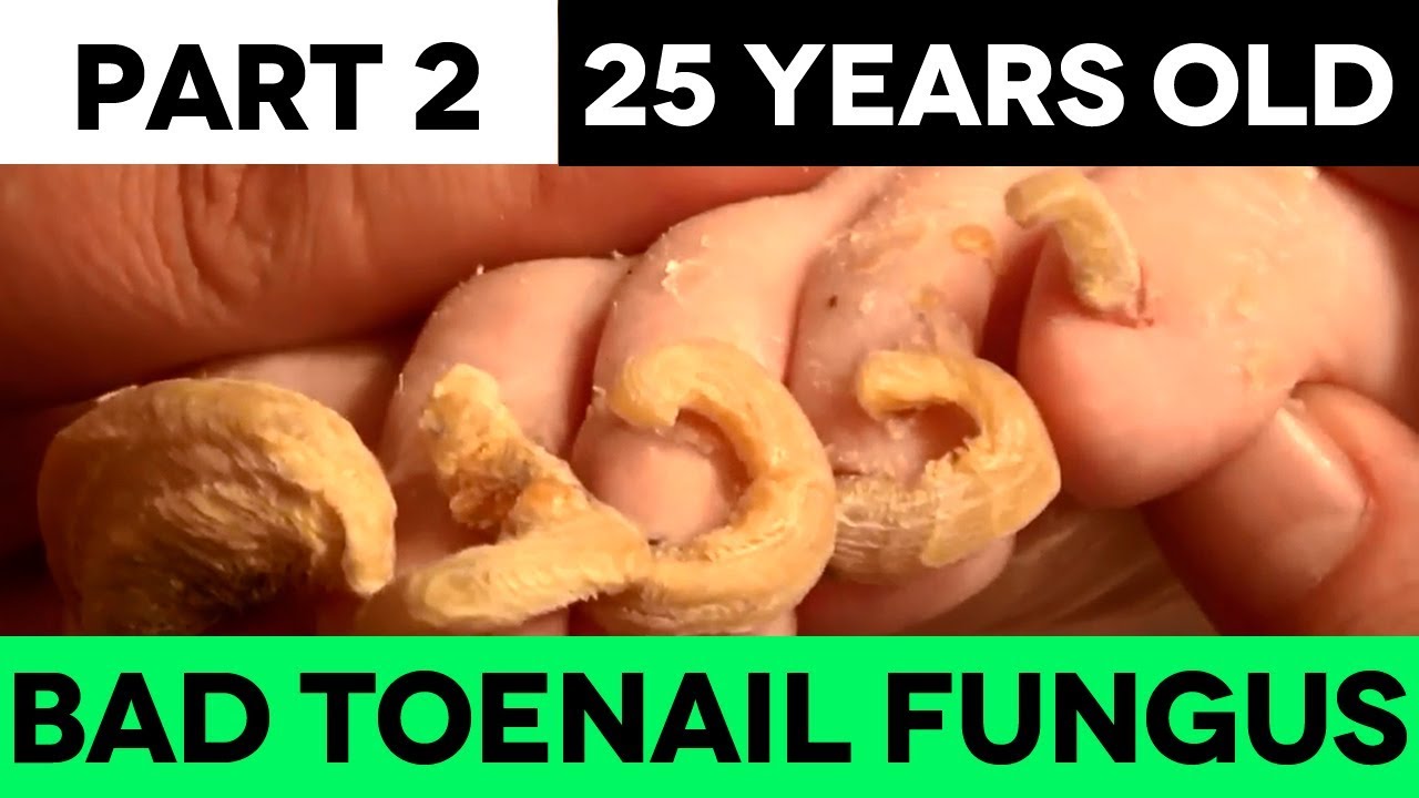 25 Years Old Severe Toenail Fungus Treatment (PART 2) YouTube