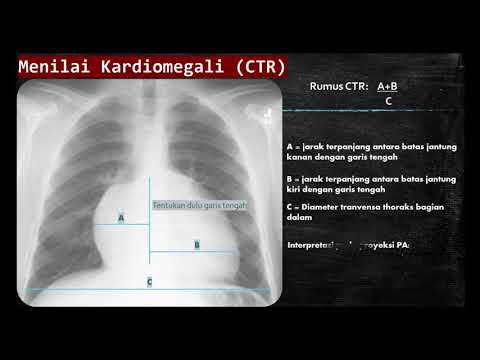Video: Forskellen Mellem Kardiomegali Og Kardiomyopati