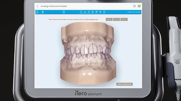 iTero Scanner Tutorial Invisalign Outcome Simulator
