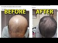 The one hair loss reversal treatment that works 999 but most arent willing to do