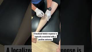 Dry needling for tight calves #dryneedling #physicaltherapy #running