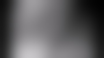 Cholangioscopy & Whipple to stage & treat Cholangiocacinoma