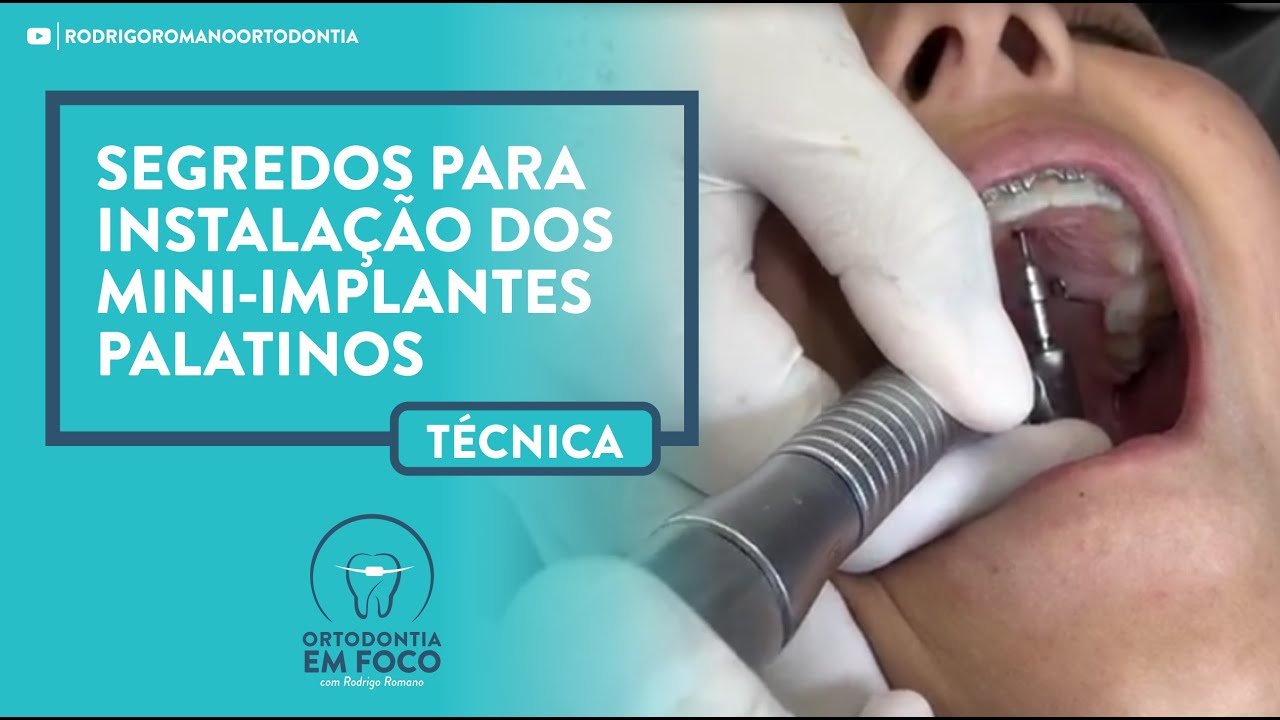 Segredos para instalação dos mini-implantes palatinos
