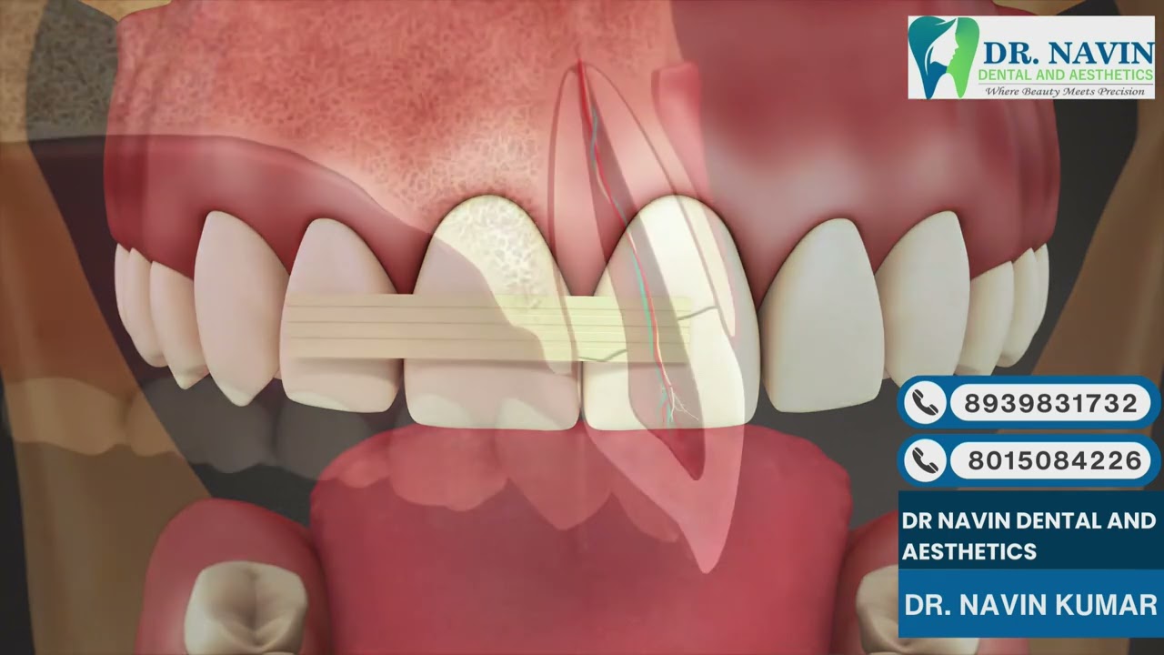 14  Trauma  Root Fracture