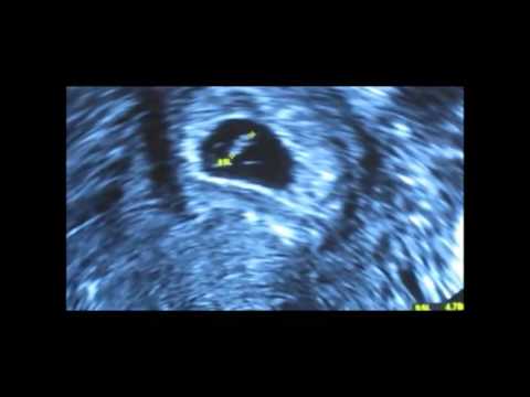Ssw ist in der gebärmutter eine fruchthöhle nachweisbar. 