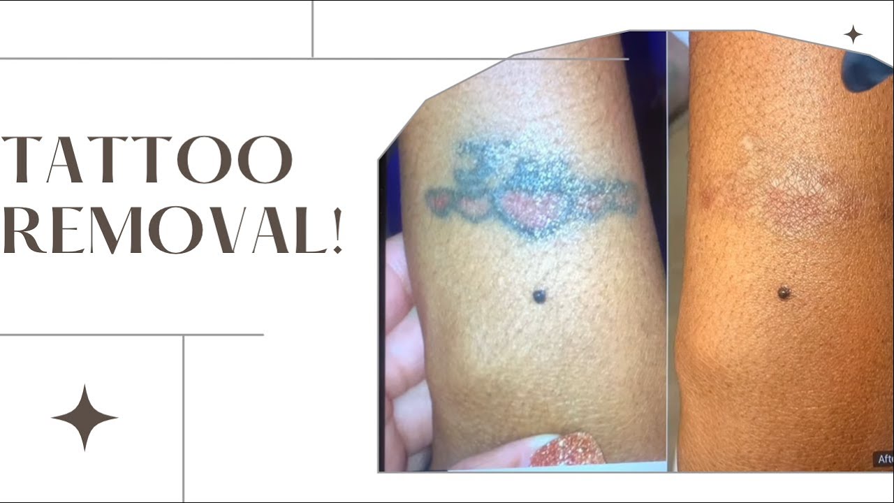 UPDATE!!! LASER TATTOO REMOVAL! ALL THE DETAILS!