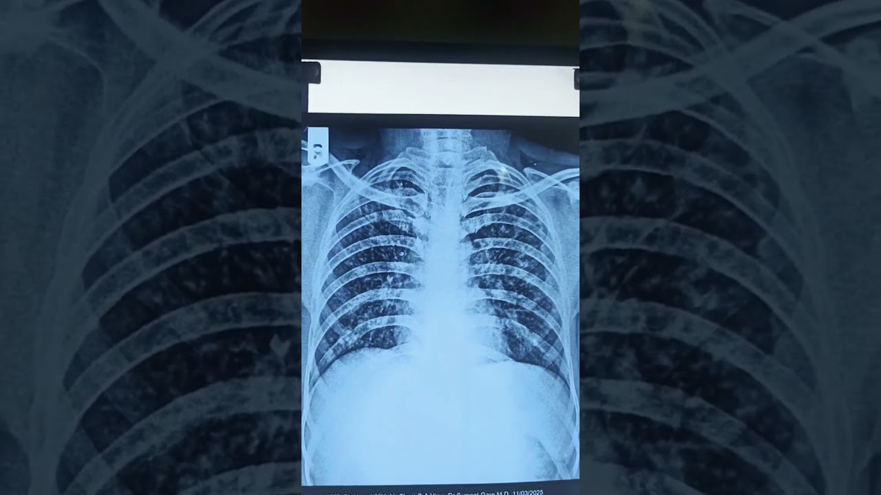 Abnormal chest PA Xray 