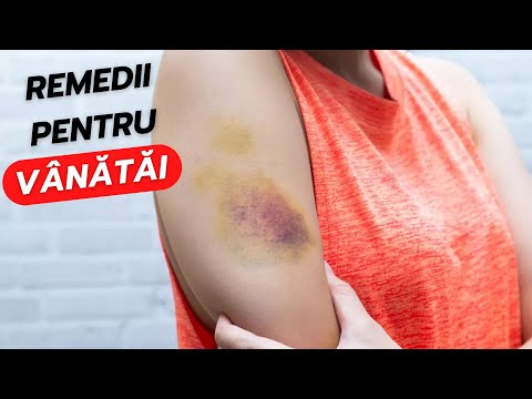 Video: Remedii Populare Pentru Vânătăi, Hematoame și Vânătăi: Cele Mai Eficiente