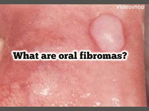 Video: Fibroma - Fibroma Põhjused Ja Sümptomid, Diagnoosimine, Ravi Ja Ennetamine