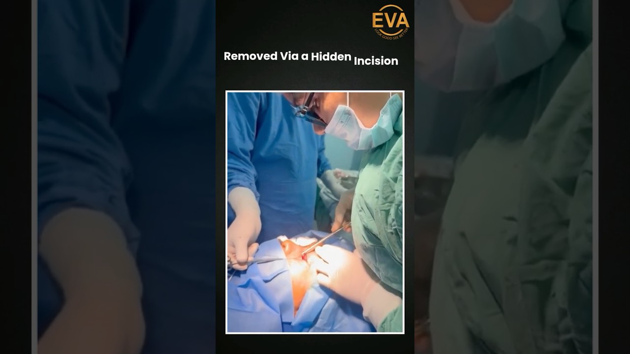 Get ridof #eyebags#scarlesssurgery #blepharoplastysurgery#drhiranmayijha #eyelidlift