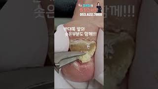 우뚝솟은 발톱?? #shorts #내성발톱 #무좀발톱  #문제성발 #ingrown #toenails