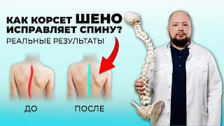 Современное лечение сколиоза: как помогает корсет Шено