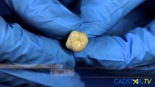 Chairside CEREC Implants and Abutments, with James Klim, DDS