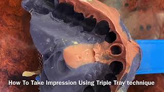 How to take good impression using triple tray technique