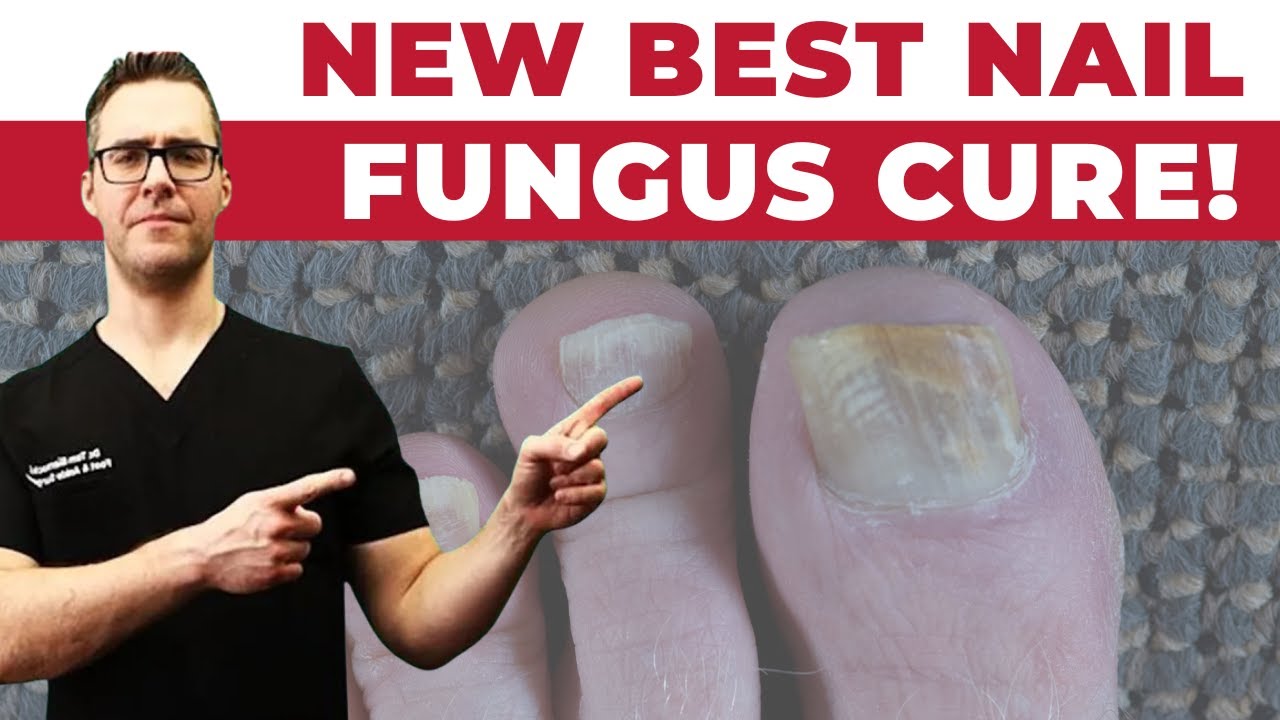 1 NEW Best Toenail Fungus Treatments [Medications vs Creams vs Laser
