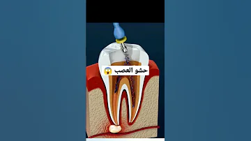 كيف يتم حشو عصب الاسنان 