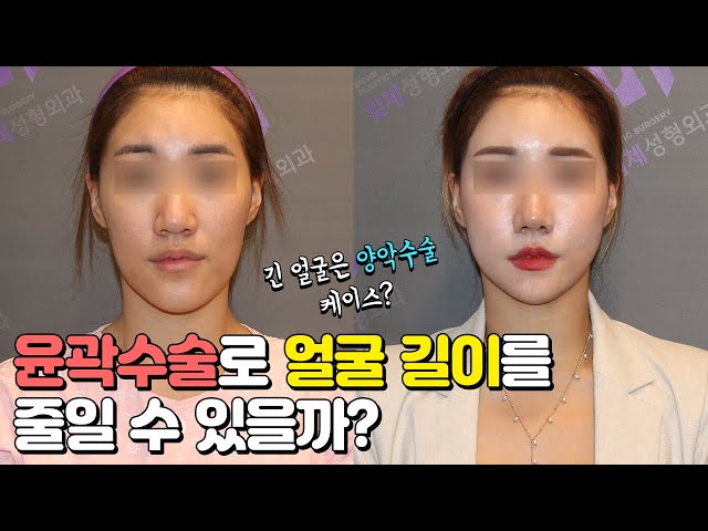 긴얼굴, 긴턱 효과적으로 줄이는 방법?! (feat. 안면윤곽수술)
