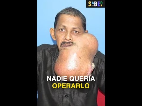 Su tumor pesaba 6 kilos y nadie quería operarlo #medicina