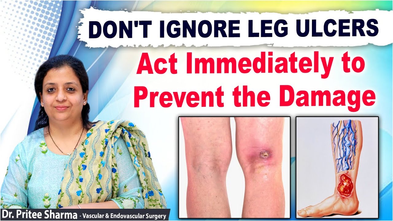 What Causes Leg Ulcers? | How to Treat Leg Ulcer Permanently? | Dr Pritee Sharma | Renova Hospitals