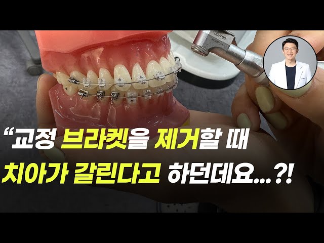 교정 브라켓 제거할 때 치아가 갈리고 아프다던데요?!(브라켓 제거 통증, 자연치아 갈림)