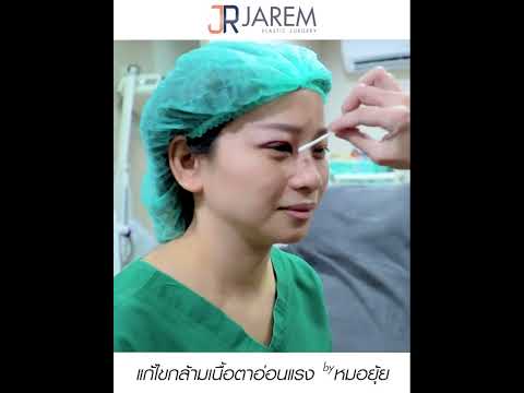 กล้ามเนื้อตาอ่อนแรงแต่กำเนิดข้างเดียว หลังทำตาเสร็จทันที หมอยุ้ยJarem clinic