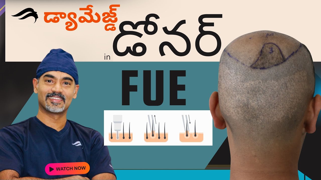 Hair Transplant In Hyderabad | Best Cost Clinic & Surgeon Of Hair Transplant Surgery In Hyderabad