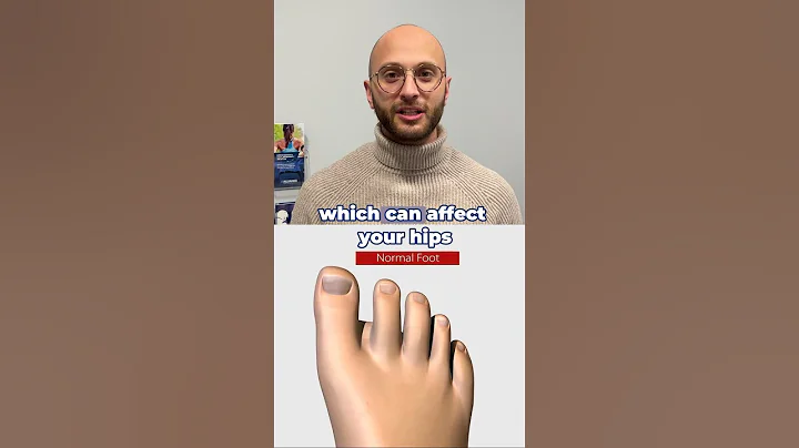 Say Goodbye to Bunion Pain with Minimally Invasive Surgery! | Faster Recovery, Less Pain