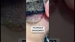 Узнать цену на  Псорифенак можно на Wildberries. Артикул -430728516