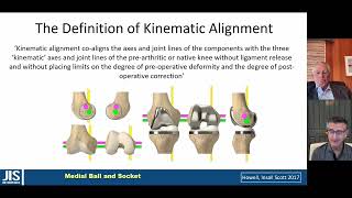 Caliper Verified Kinematic Alignment TKA – MEDACTA TV