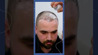 Premium Hair Transplant in Turkey 🇹🇷 Natural Results with Micro FUE | Book Free Consultation