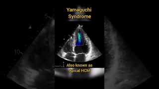 Apical Hypertrophic Cardiomyopathy (HCM) or Yamaguchi syndrome #echocardiography