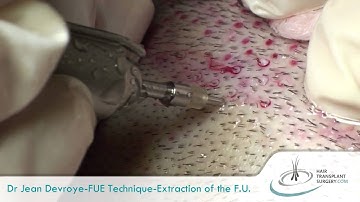 Dr Devroye FUE (extraction of the follicular units) Hair Transplant Surgery
