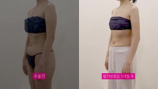 바비라인의원 팔지방흡입 5개월 후 전후영상