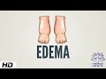 Edema, Causes, Signs and Symptoms, Diagnosis and Treatment.