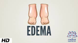 Edema, Causes, Signs and Symptoms, Diagnosis and Treatment. screenshot 5