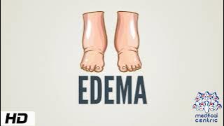 Edema, Causes, Signs and Symptoms, Diagnosis and Treatment.